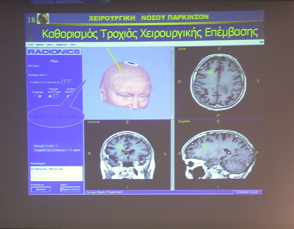 Έως το 2040, η νόσος Πάρκινσον θα έχει ξεπεράσει σε συχνότητα εμφάνισης τον καρκίνο