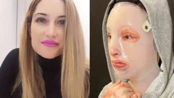 Ιωάννα Παλιοσπύρου – Δημοσίευσε σοκαριστικές φωτογραφίες μετά την επίθεση με το βιτριόλι (σκληρές εικόνες)