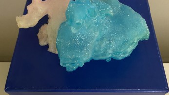 Δημήτρης Αυγερινός: Τρισδιάστατες εκτυπώσεις καρδιάς πραγματοποιούνται συστηματικά στο Ωνάσειο