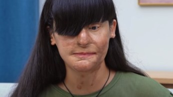 Τουρκία: Της έριξε οξύ στο πρόσωπο και τρία χρόνια μετά παντρεύτηκαν