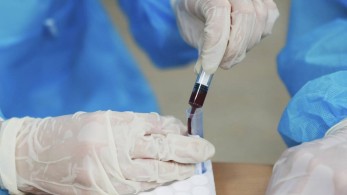 Ευλογιά των πιθήκων: Επιβεβαιώθηκε το πρώτο κρούσμα στην Ελλάδα