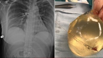 Καναδάς: Εμφύτευμα σιλικόνης “απέκρουσε” σφαίρα!