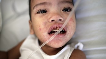 Ιλαρά: Σε επαγρύπνηση οι αρχές  - Ανησυχία από ΠΟΥ και ECDC για την αύξηση κρουσμάτων