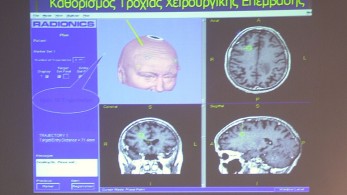 Έως το 2040, η νόσος Πάρκινσον θα έχει ξεπεράσει σε συχνότητα εμφάνισης τον καρκίνο